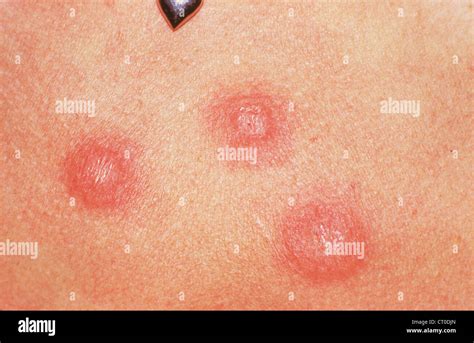 Dermatofito Fotograf A De Stock Alamy