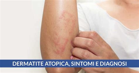 Dermatite Atopica Sintomi E Diagnosi Cardio Center Napoli