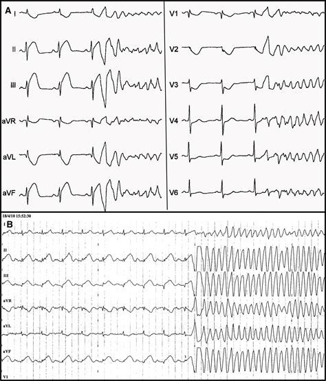 Polymorphic Ventricular Tachycardia Ecg