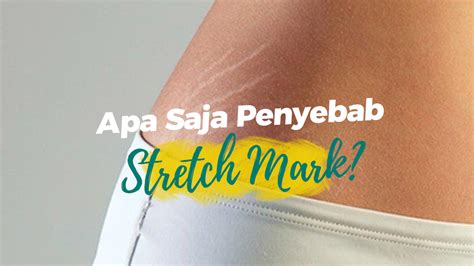 Cara Menghilangkan Stretch Mark Terbaik Dan Aman Bagi Kulit