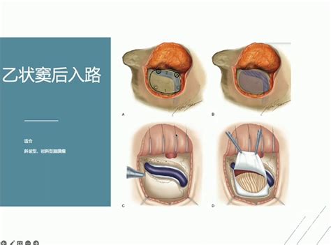 朱永华主任医师：岩斜区脑膜瘤手术治疗初探 脑医汇 神外资讯 神介资讯