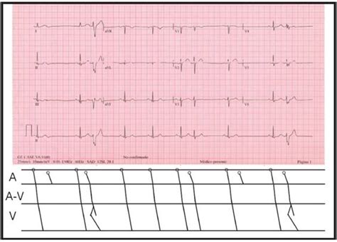 Electrocardiograma Del Mes