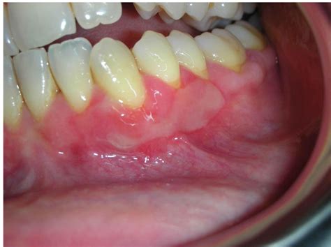 Pemfigoide Delle Membrane Mucose Medicina Orale