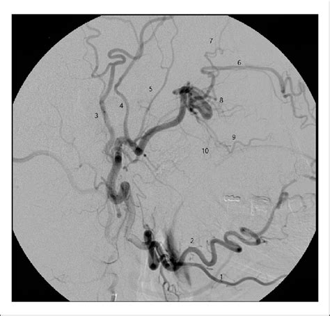 Dsa Showing Anatomy Of The Maxillary Artery 1 Submental Artery 2 Download Scientific