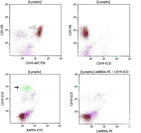 Cd10 T Cells In Aitl