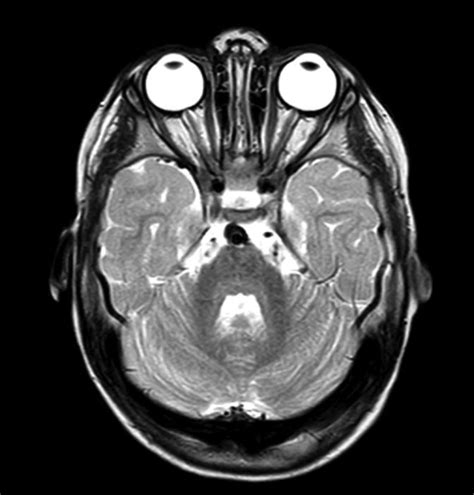 Axial T2 Mri Of The Brain Demonstrating Posterior Globe Flattening