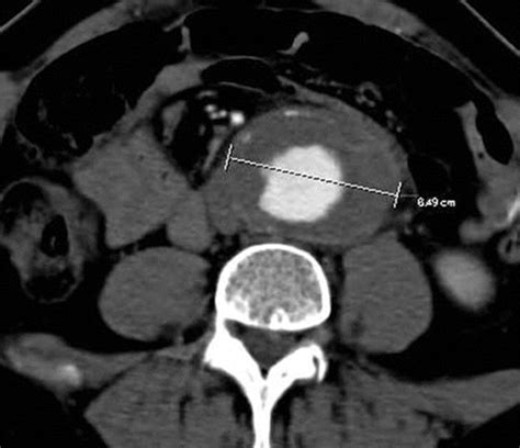 Abdominal Aortic Aneurysm Lateral Xray