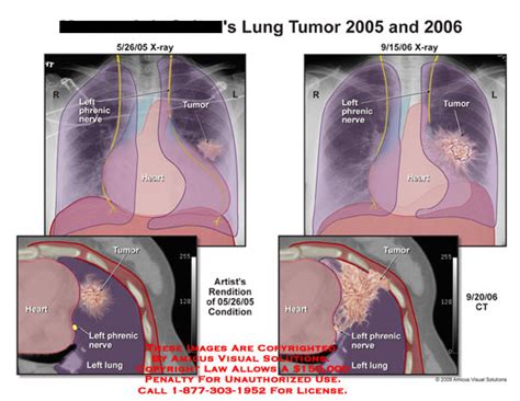 Amicus Illustration Of Amicus Radiology Lung Tumor X Ray Ct Phrenic