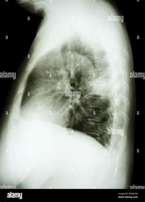 Xray Of Lung Cancer Hi Res Stock Photography And Images Alamy