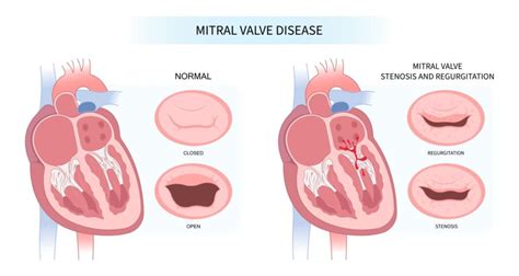 Understanding Mitral Valve Disease