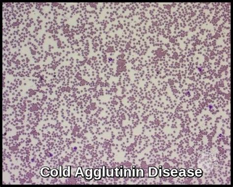 Cold Agglutinin Disease Ask Hematologist Understand Hematology