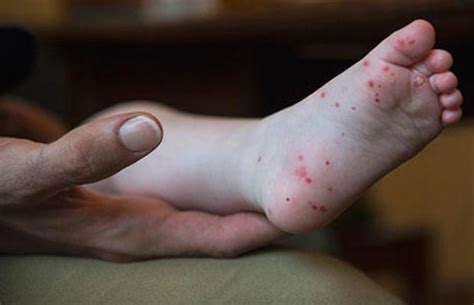 Hand Foot And Mouth Disease Cases Flare Up In Several States Cbs News