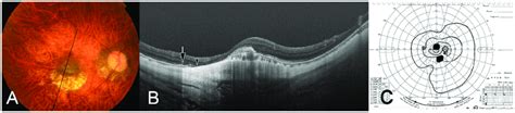 Dome Shaped Macula Dsm Co Existing With Macular Bruch S Membrane Download Scientific Diagram