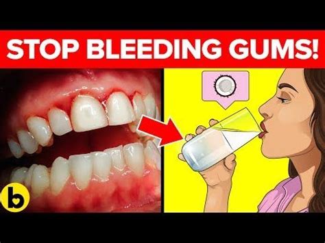 16 Expert Techniques For Stopping Your Bleeding Gums YouTube