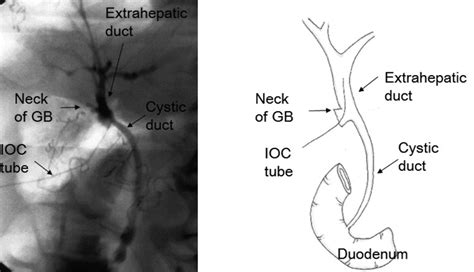 Cholangiography Procedure Off Micoope Gt