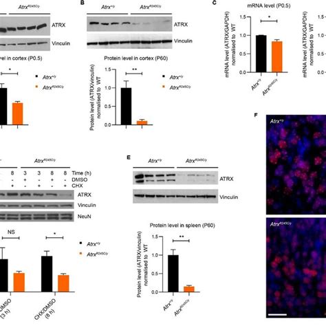 The R245C Mutation Impacts ATRX Protein Stability And Binding To