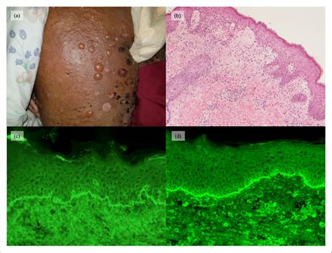 Case 1 Erosions And Tense Non Hemorrhagic Vesicles And Bullae On The