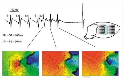 Nonsustained ventricular monomorphic VT after premature stimulation at ...