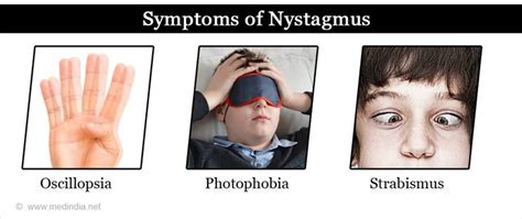 Nystagmus - Types, Causes, Symptoms, Diagnosis, Treatment & Prevention ...