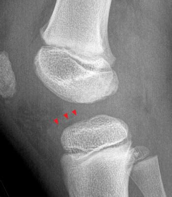 Tibial Intercondylar Eminence Fractures | Radsource