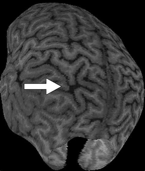 Bottom Of Sulcus Dysplasia Imaging Features AJR