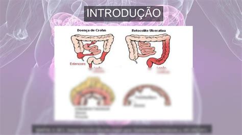 Solution Doen As Inflamat Rias Intestinais Semin Rio Etapa Studypool