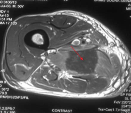 Figure 1B: Diffuse hyperintense signal on T2-weighted imaging ...