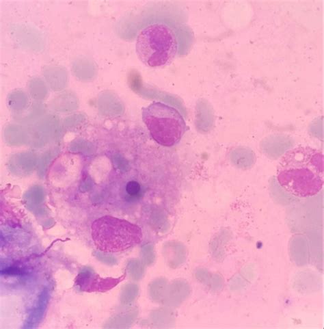 Bone Marrow Aspirate Showed Histiocyte Engulfing Late Erythroid