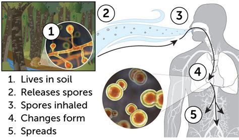 4 Key Things To Know About Lung Infections Caused By Fungi