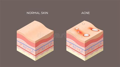 Acne Vulgaris Or Pimple And Normal Skin Cross Section Of Human Skin