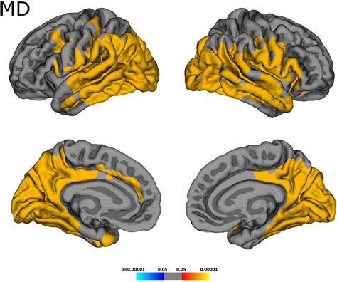 Frontiers Distribution Of Cortical Diffusion Tensor Imaging Changes