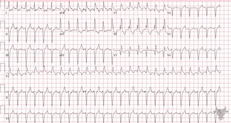 Left Anterior Fascicular Block Ecg Stampede