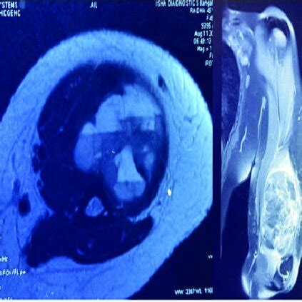 Mri Showing A Heterogeneous Well Defined Mixed Solid Cystic Enhancing