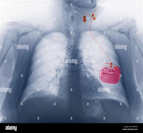 Chest X Ray Showing A Vagus Nerve Stimulator For Epilepsy Stock Photo