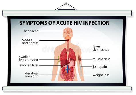 Carta Que Mostra Sintomas Da Infec O Pelo Hiv Aguda Ilustra O Do