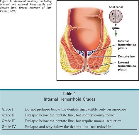 Figure From Definitive Therapy For Internal Hemorrhoids New