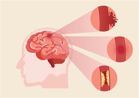 Key Warning Signs Before A Stroke