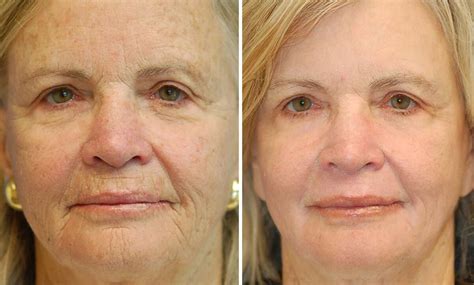 Sciton® Erbium Laser Skin Resurfacing Napa Solano Plastic Surgery And Medspa