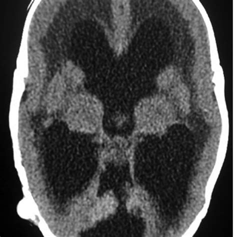 WWS, type II lissencephaly (cobblestone appearance), MRI, axial cuts T2 ...