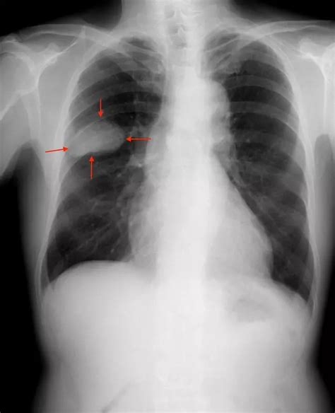 Lung Cancer X Ray Photos — Examples Of Different Types Of Results