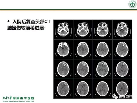 多学科治疗颅脑损伤合并多发伤继发脑脓肿患者一例丨 颅脑创伤 神经重症病例周刊（89期） 脑医汇 神外资讯 神介资讯