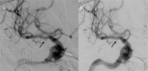 Iatrogenic Middle Cerebral Artery Ruptured Pseudoaneurysm Successfully