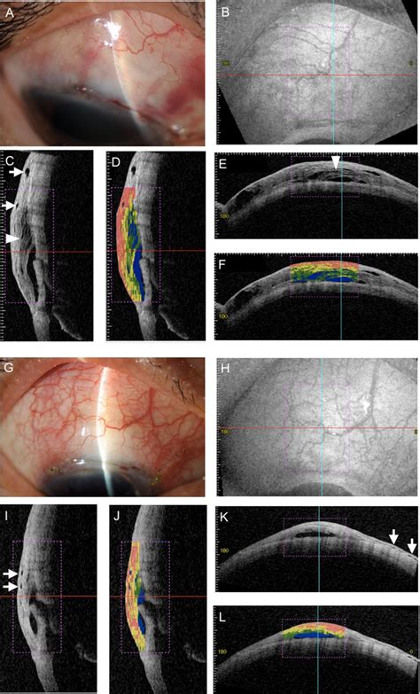 Characteristics Of Early Filtering Blebs That Predict Successful