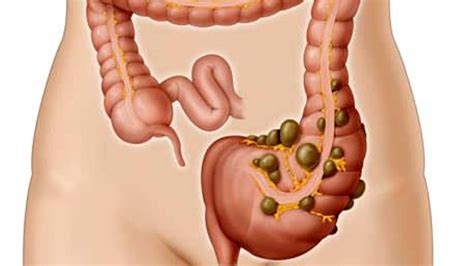 Diverticulitis causas y síntomas