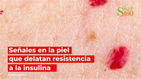 Señales en la piel que delatan la resistencia a la insulina Salud 180