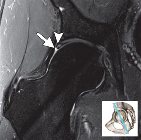 Demystifying Radial Imaging Of The Hip RadioGraphics