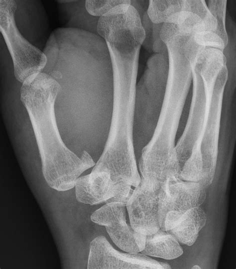 Bennett Fracture Image