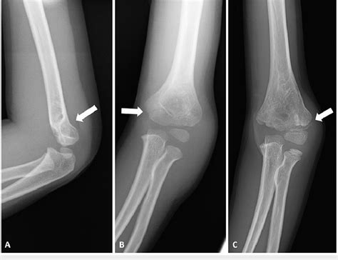 Plain Radiography Of The Serial Fractures At The Left Elbow A The