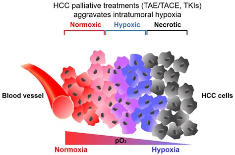 Cells Free Full Text Hypoxia Metabolic Reprogramming And Drug Resistance In Liver Cancer