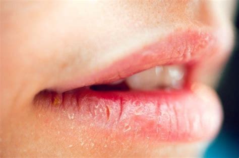 Consejos Para Combatir Los Labios Agrietados O Secos Farmalink Pe